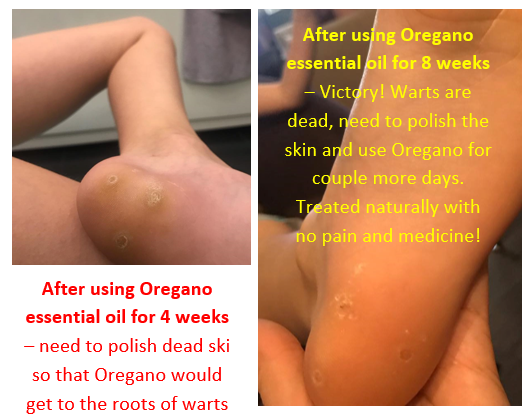 Essential oils clearance for warts